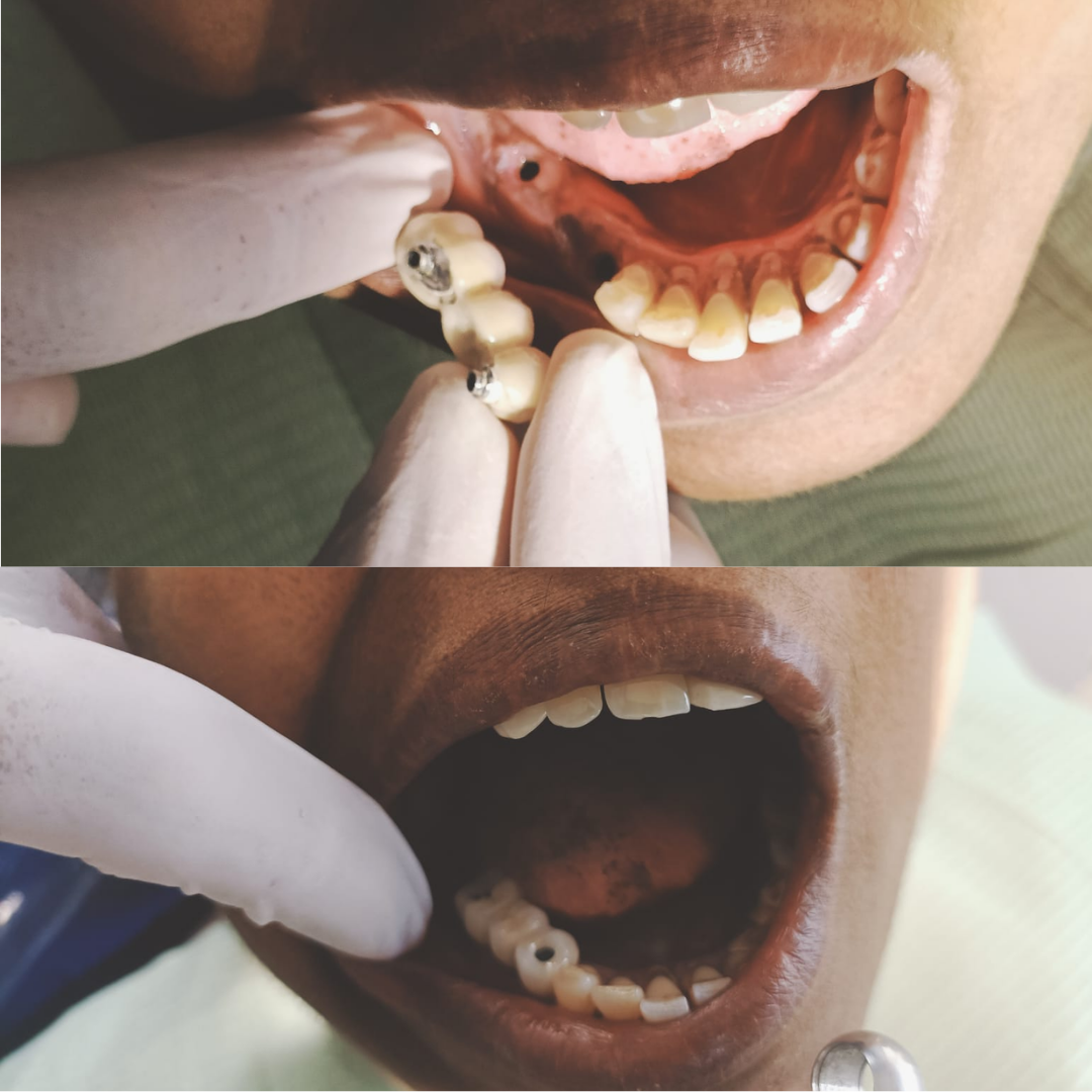 _Best pediatric dentist in Valasaravakkam (4)