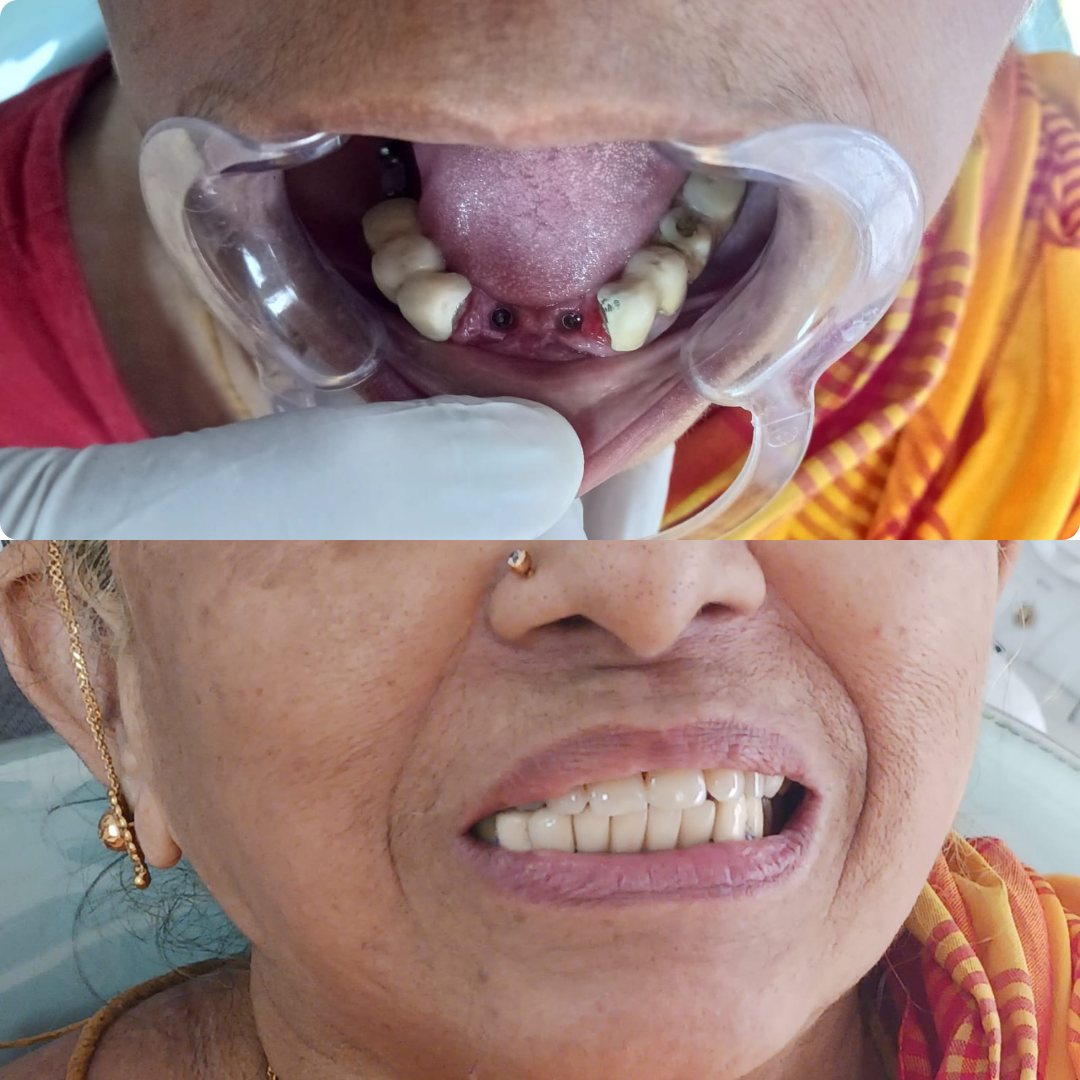 _Best pediatric dentist in Valasaravakkam (6)